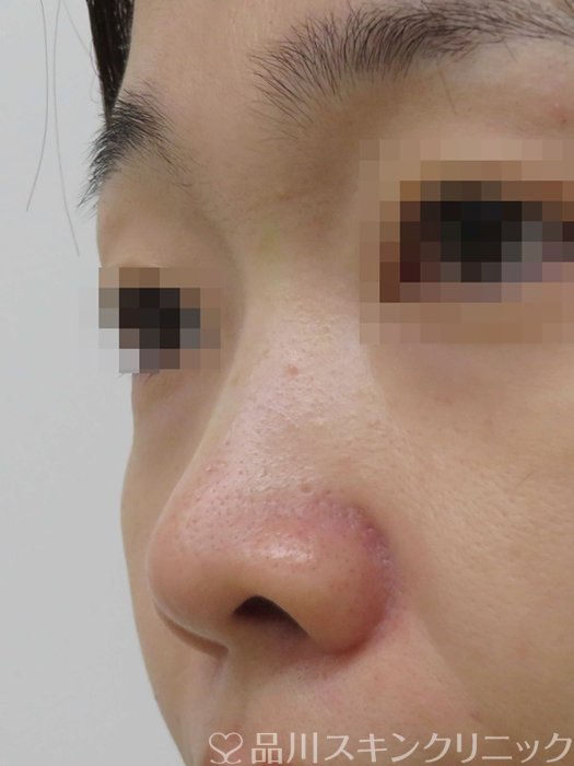 症例NO.71220のBEFORE写真