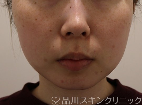 症例NO.72721のAFTER写真