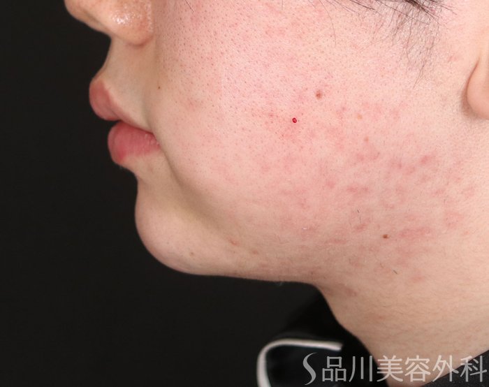 症例NO.73757のAFTER写真