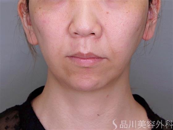 症例NO.48813のBEFORE写真