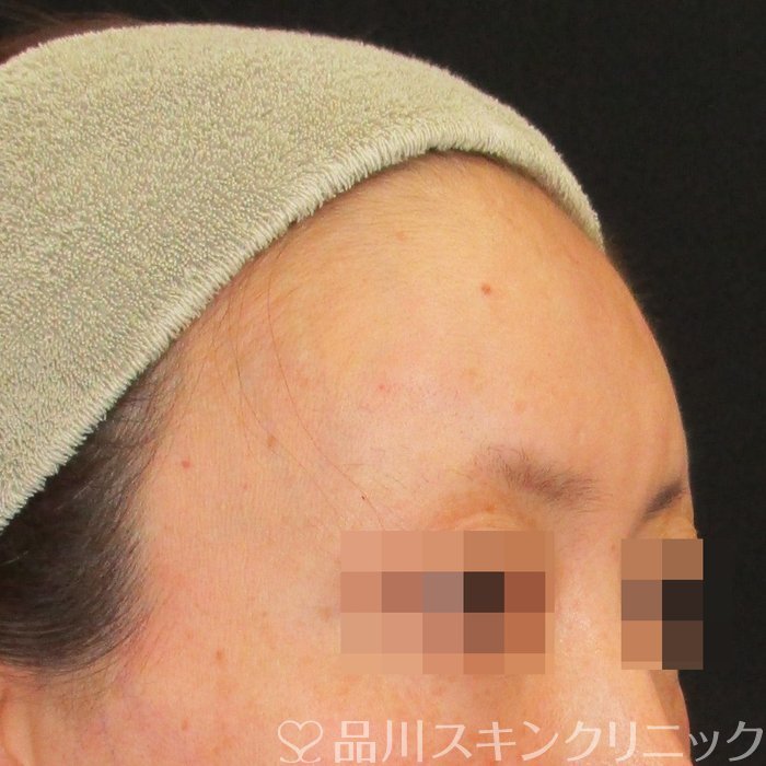 症例NO.74631のAFTER写真