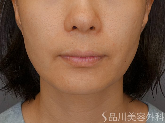 症例NO.71462のBEFORE写真