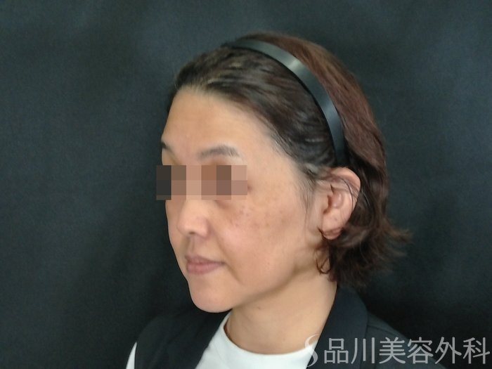 症例NO.70839のBEFORE写真