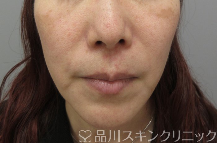 症例NO.70329のBEFORE写真