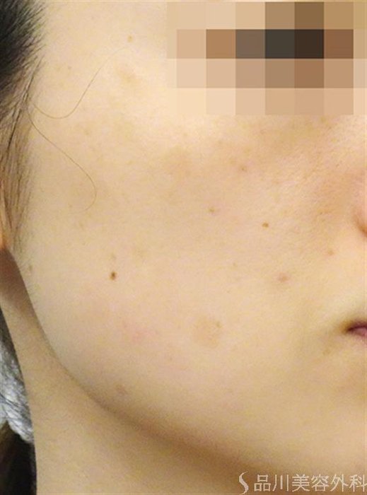 症例NO.24578のAFTER写真