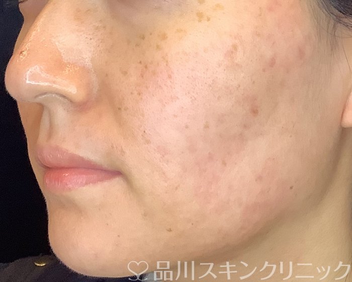 症例NO.69780のAFTER写真