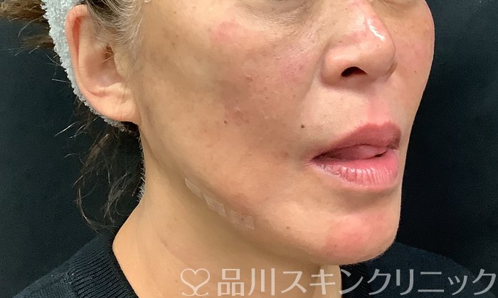 症例NO.67887のAFTER写真