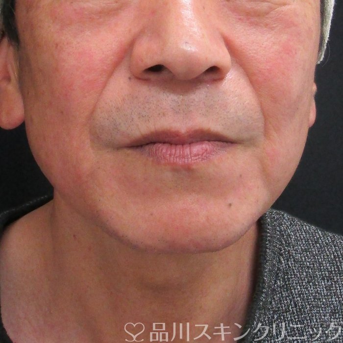 症例NO.74154のBEFORE写真