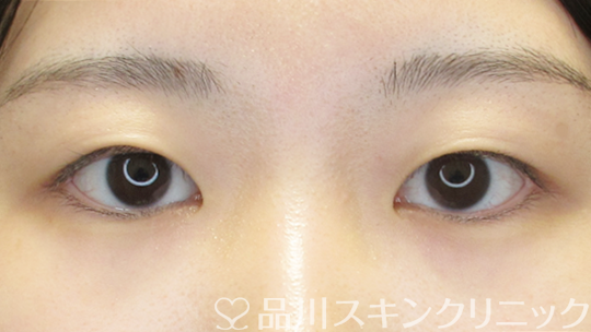 症例NO.69509のBEFORE写真