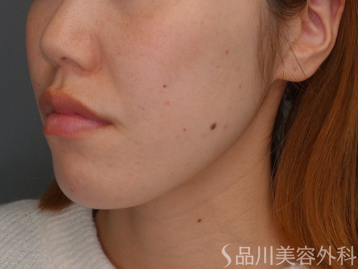 症例NO.63619のBEFORE写真