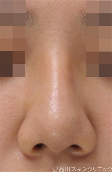 症例NO.38026のAFTER写真