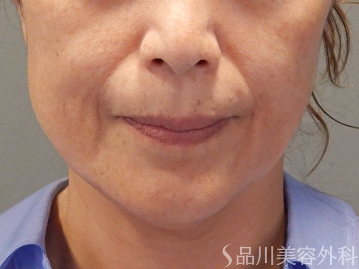 症例NO.71484のBEFORE写真