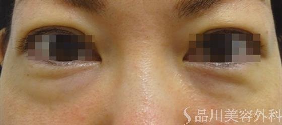 症例NO.43296のBEFORE写真