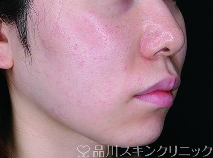 症例NO.70477のAFTER写真