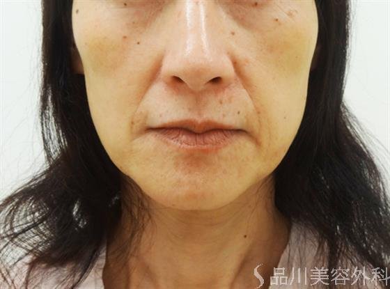 症例NO.30517のBEFORE写真
