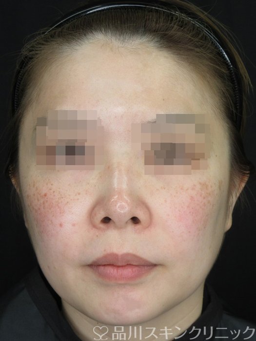 症例NO.73228のBEFORE写真