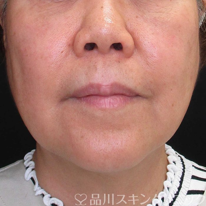 症例NO.69988のBEFORE写真