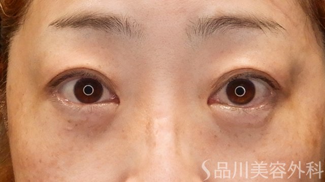 症例NO.75229のAFTER写真