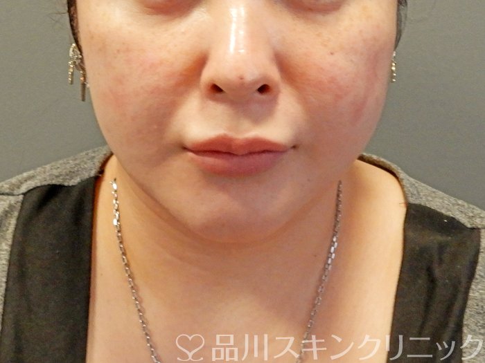 症例NO.67477のAFTER写真