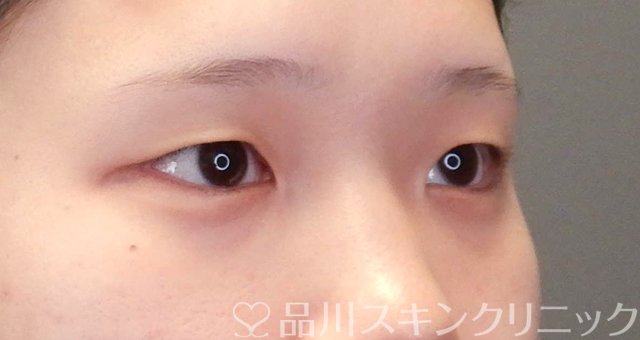 症例NO.66303のBEFORE写真