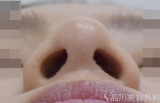 症例NO.47156のAFTER写真