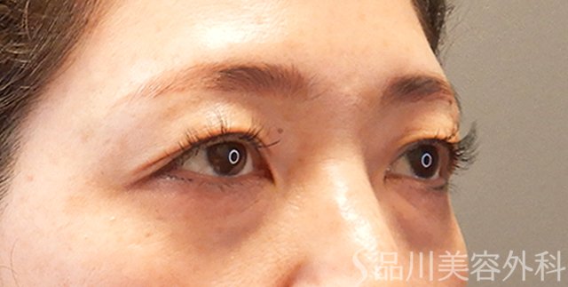 症例NO.70617のBEFORE写真