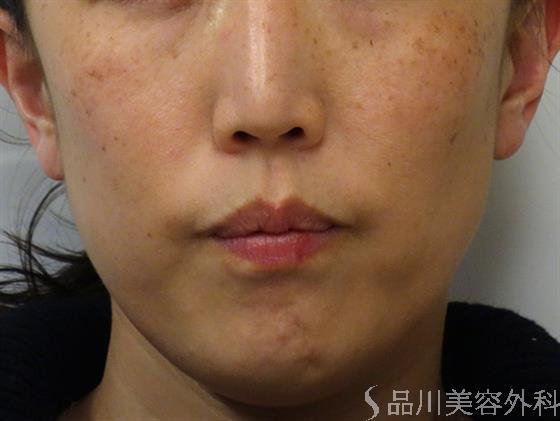 症例NO.41206のBEFORE写真