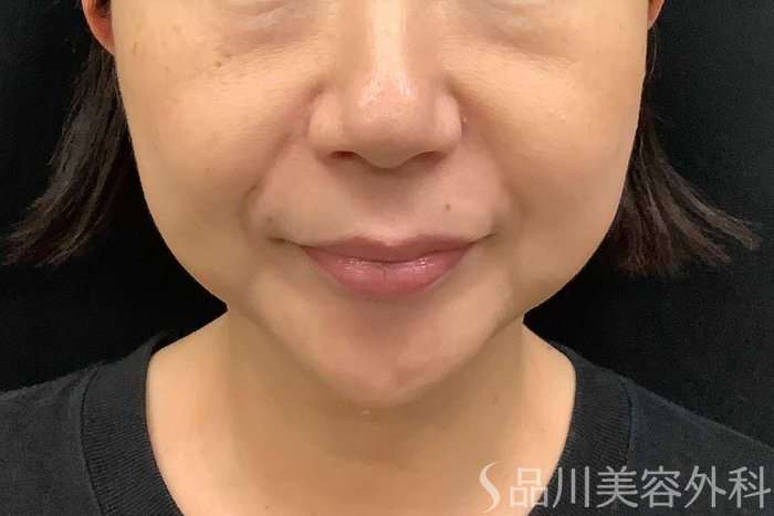 症例NO.69779のBEFORE写真