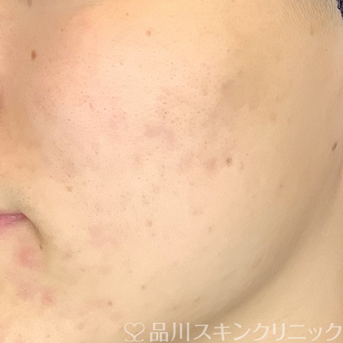 症例NO.69486のAFTER写真