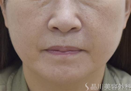 症例NO.51899のAFTER写真