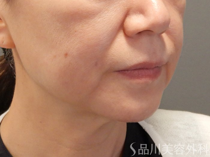 症例NO.71112のBEFORE写真