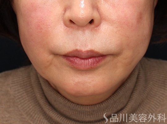 症例NO.73015のAFTER写真