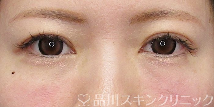 症例NO.74832のAFTER写真
