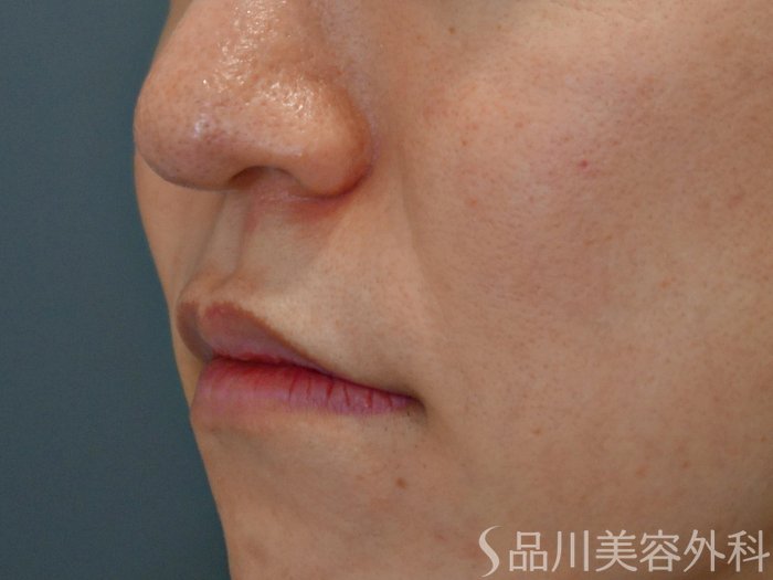 症例NO.72156のBEFORE写真