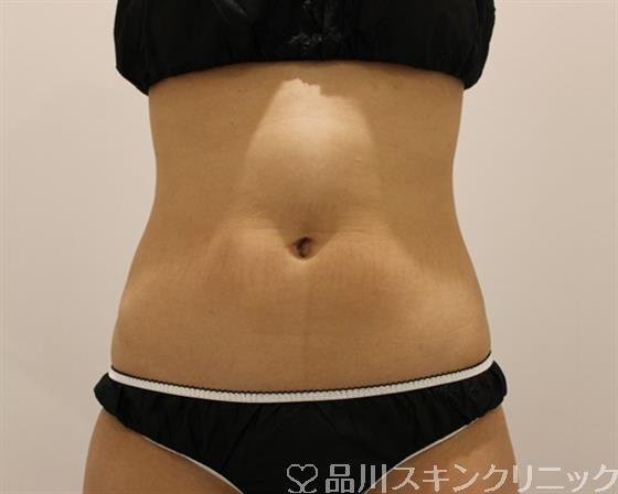 症例NO.50344のBEFORE写真