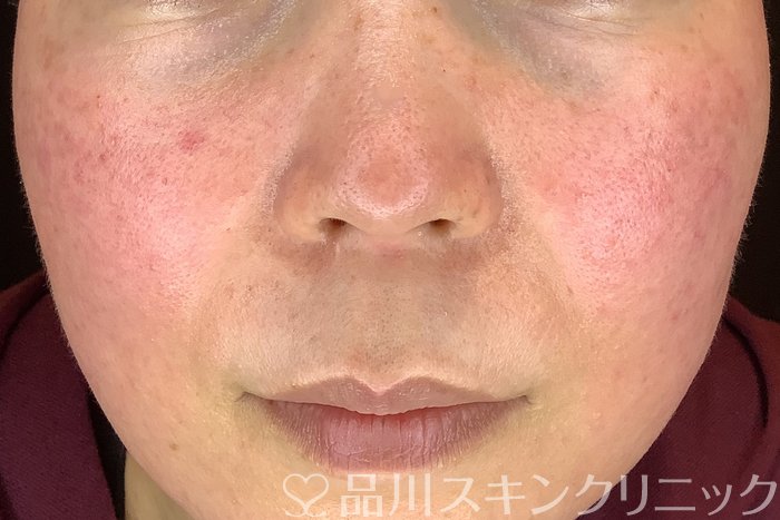 症例NO.64802のBEFORE写真