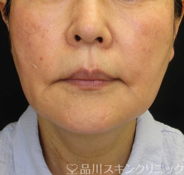 症例NO.68051のBEFORE写真