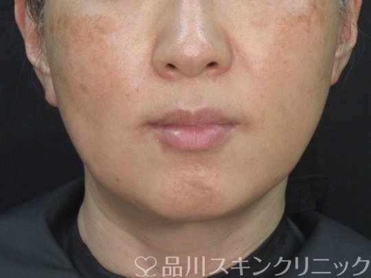 症例NO.72754のAFTER写真