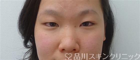 症例NO.47038のBEFORE写真