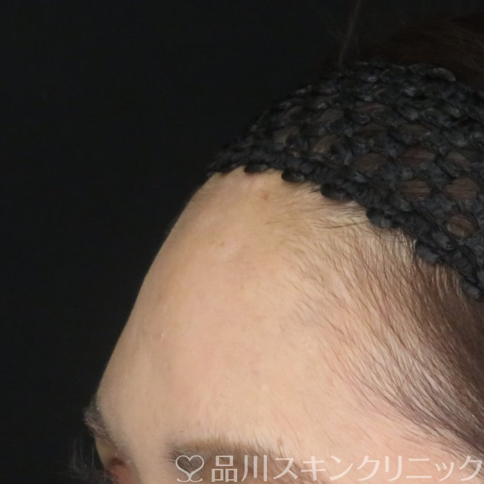 症例NO.62127のBEFORE写真