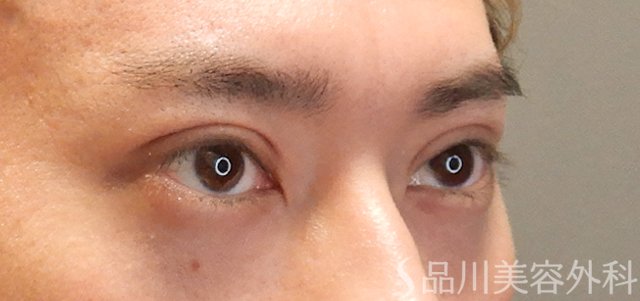 症例NO.72151のAFTER写真