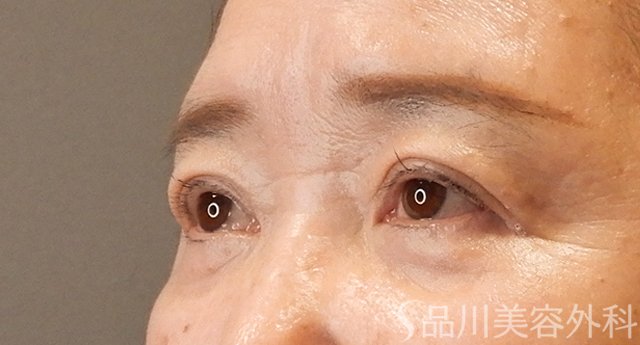 症例NO.75353のAFTER写真