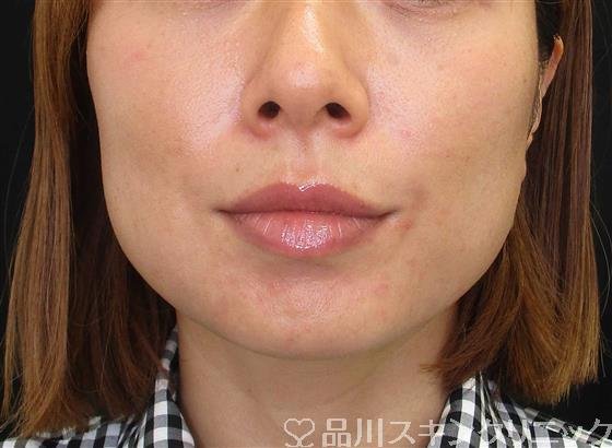 症例NO.61916のBEFORE写真