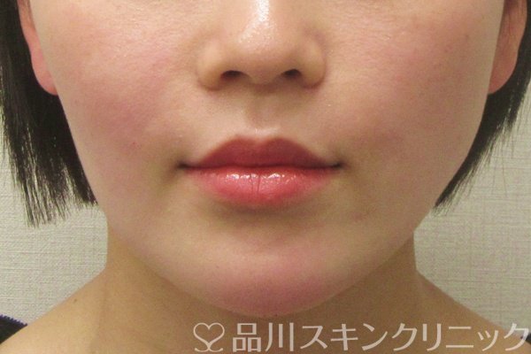 症例NO.75078のAFTER写真