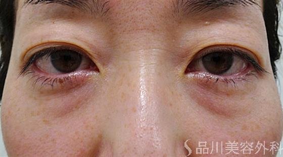 症例NO.54274のBEFORE写真