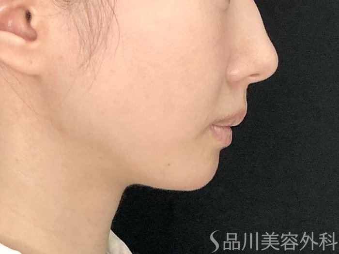 症例NO.71630のAFTER写真