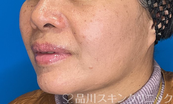 症例NO.74512のAFTER写真