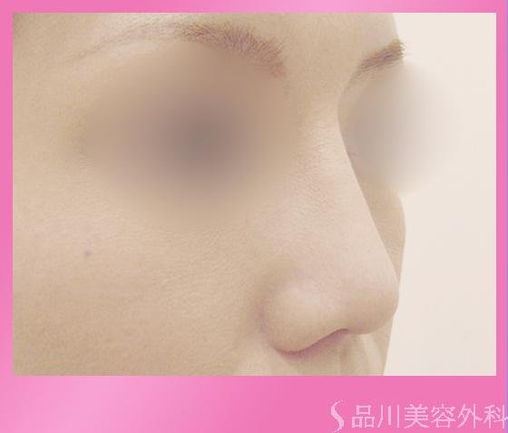 症例NO.2060のAFTER写真