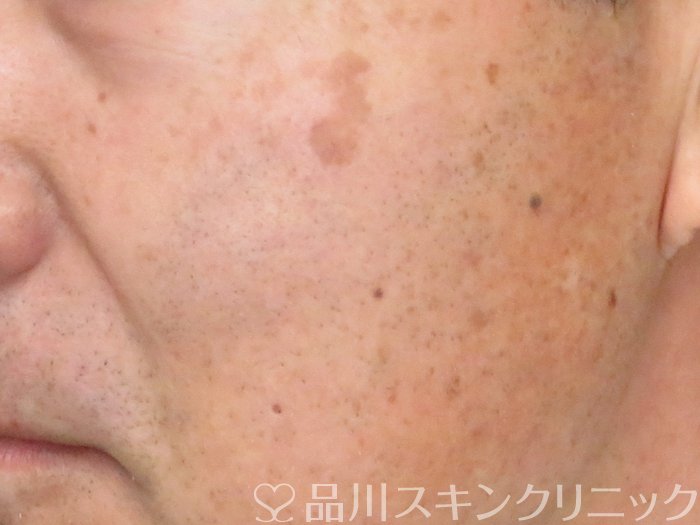 症例NO.69619のBEFORE写真
