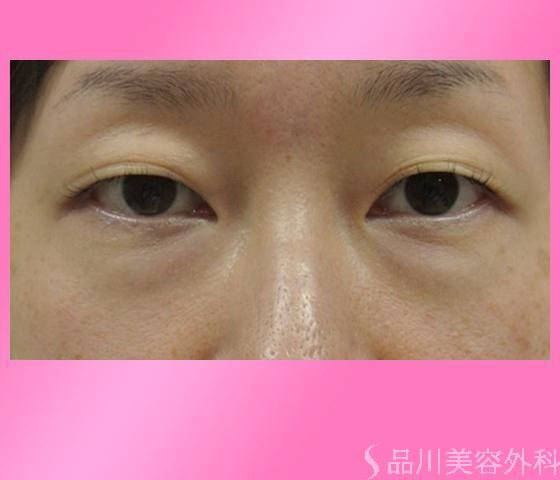 症例NO.14481のBEFORE写真